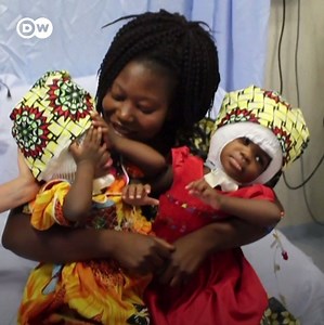 12K views · 364 reactions | These two-year-old conjoined twins were separated successfully after three risky surgeries. Even though they have to wear protective helmets for a few months, doctors believe they will be able to lead a normal life. | DW News | Facebook