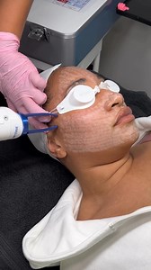 AEROLASE #EraElite ASMR 🔈❤️‍🔥 A cutting-edge solution for complete epidermal renewal. ✨ Powered by Erbium Laser Energy—the industry’s esteemed Gold Standard in resurfacing—the Era Elite® optimizes energy parameters such as fluence, pulse width, spot size, and repetition rate. This precision ensures efficient and uniform skin ablation while safeguarding surrounding tissue from thermal damage by allowing the skin to cool between pulses. ❄️ Era Elite® is the only device with short pulse 300-micro
