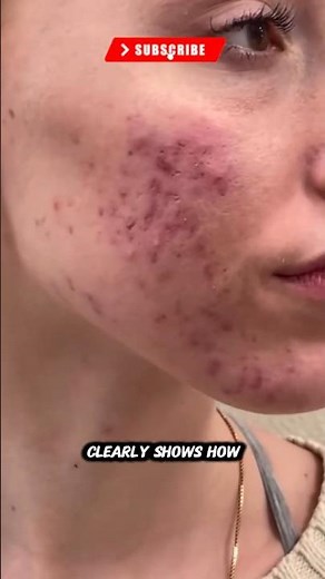 This Acne Transformation Shocked Everyone 😱 Real Before & After