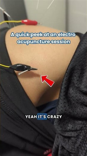 What Electro Acupuncture Looks Like 👀