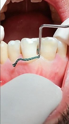 INTERPROXIMAL Cavity Dental Cavity between two teeth 🦷