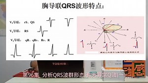 第96集 分析QRS波群形态，有无异常Q波（一）