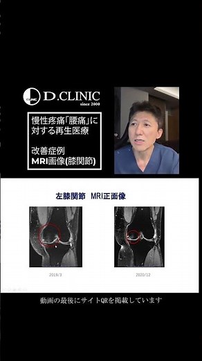 腰痛・椎間板ヘルニアが治らない・慢性疼痛の方へ07｜再生医療という新しい選択肢【幹細胞治療】7改善症例：MRI画像（膝関節痛）『慢性腰痛・椎間板ヘルニアへの新しい治療法』 #腰痛改善 #ヘルニア