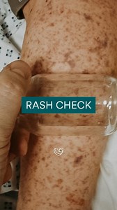 If you see a rash on your little one, perform this check 👇 Does the rash blanch? A good way to check for this is by using a clear glass and rolling it over the rash. If the rash turns white that means it blanches. A non-blanching rash doesn’t turn white when pressed on. If the rash is non-blanching it means there is bleeding beneath the skin and there are tests that should be done to rule out anything serious causing this. Share this simple but potentially life-saving hack with other parents 💜