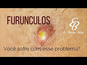 FURÚNCULOS SAIBA COMO TRATAR Dr Edelson Beling