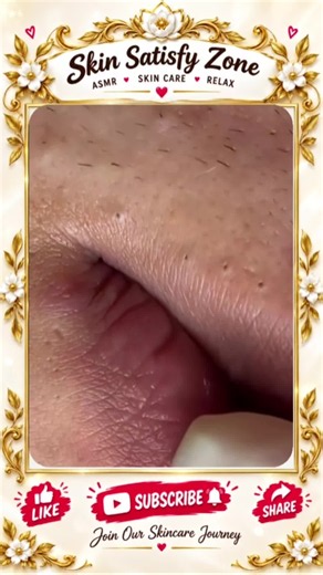 Deep Blackhead Extraction & Satisfying Popping | Wait for the most satisfying pop 😳🫣 You won’t believe what comes out! #pimplepoppersatisfying #Acne #pimple #Blackhead #Satisfying