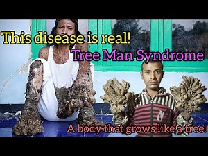 Tree Man Disease | The Terrifying Secret of the Skin That Makes a Man Look Like a Tree #Tree_Man