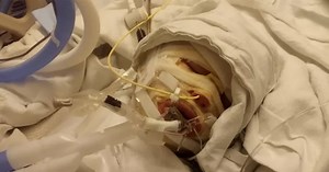 6-year-old boy severely burned after accidental backyard bonfire explosion