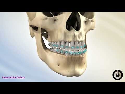 Surgery for Mandibular Setback - Class 3