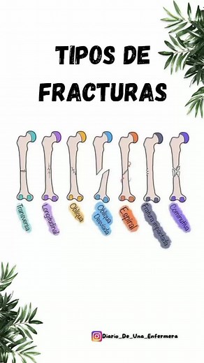 Tipos de fracturas en enfermería: Diario de una enfermera película