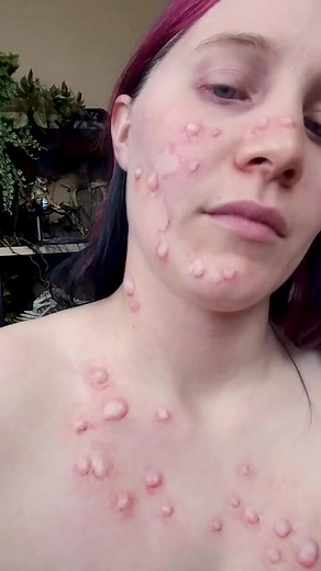 Better than Dr Pimpled Popper? 藍 FAKE An old makeup removal video of silicone boils I did for Halloween a few years back. Is this satisfying or gross? 藍 . . #makeupremoval #pimplepopper #halloweenmakeupartist #halloweenmakeupvideo #specialeffectsmakeupartists #bodypainting #witteartistry | Witte Artistry | Facebook