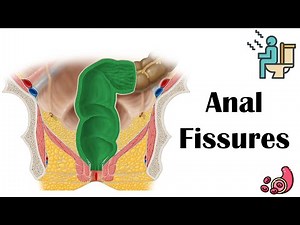Anal Fissures - Causes, Risk Factors, Pathophysiology, Signs & Symptoms, Diagnosis, & Treatment