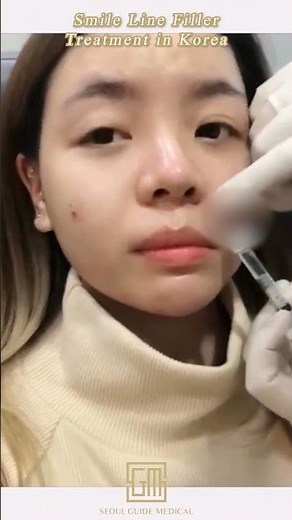 Smile Line Filler Treatment in Korea | Seoul Guide Medical
