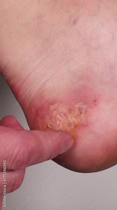 Woman scratching her heel with her finger or nail and peeling of some old skin pieces. Huge wound on female foot after several confluent blisters of eczema. Acute psoriasis, allergic reaction on foot.