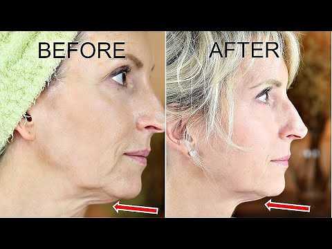 Skin Tightening Anti Aging Device Review | EvenSkyn LUMO | Before & After
