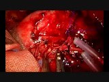 Uniportal VATS Vascular Anastomosis During Double Sleeve • Video • MEDtube.net
