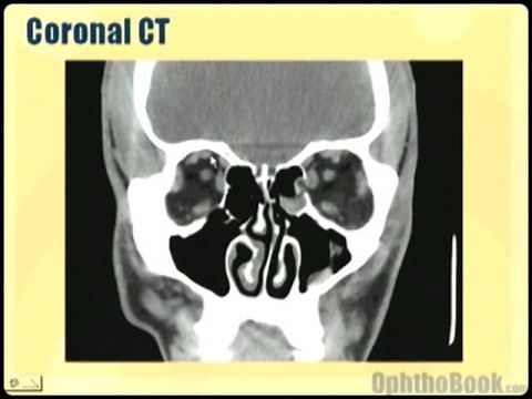 Ophthalmology Lecture - Eye Anatomy Part 3
