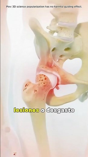 Hip Replacement Surgery (3D Animation)#hipreplacment #hiparthritis #hiparthritisrelief