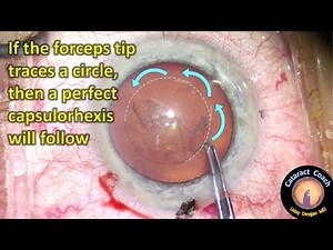 Capsulorhexis made simple for beginning Cataract Surgeons