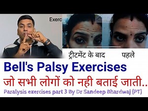Bell’s palsy exercises, आधे चेहरे का लकवा? || Facial paralysis exercise ‪@Drsandeepbhardwaj‬