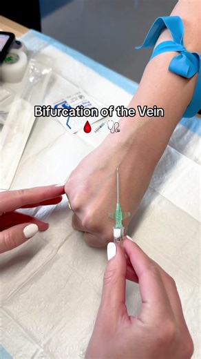 Understanding Bifurcations in Veins: Avoiding Risks and Best Practices