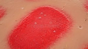Simulation of Dandruff Formation Process in Human Skin with Growing Hair Follicles Animated Medical Visualization 3D Animation Stock Video - Video of follicles, dandruff: 415013829
