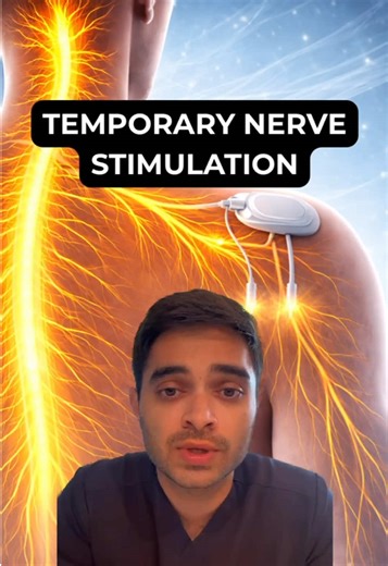 Not all nerve pain needs surgery, permanent implants, or long term medications. Temporary peripheral nerve stimulation is a short term therapy designed to calm overactive pain nerves and retrain how the brain processes those signals. A tiny wire is placed near the nerve sending pain messages and delivers gentle electrical stimulation for about 60 days. For the right type of nerve pain, this can significantly reduce pain when other treatments have not been enough. The goal is not just relief whil