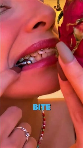 🦷✨ The Herbst Device: How It Fixes Your Jaw Bite!