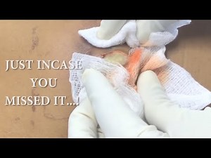 Squeezing abscess full of pus * Squirt alert *