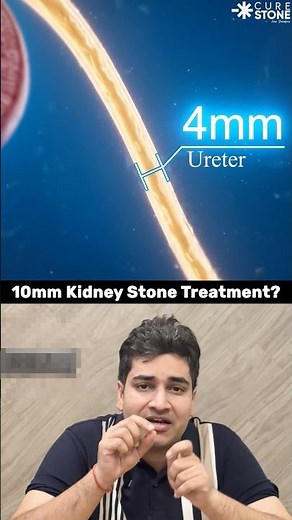 10 mm kidney stone treatment | RIRS #urology