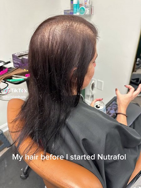 I wanted to share my hair loss journey. I started Nutrafol in October and I have had amzing results!!!!!! #nutrafol