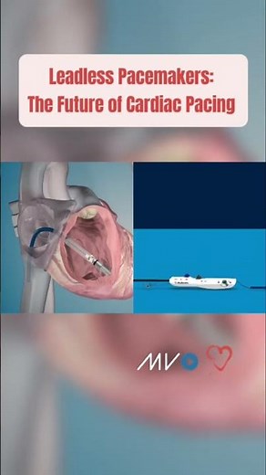 🫀 How Leadless Pacemakers Are Implanted #cardiology #hearthealth #medicaleducation