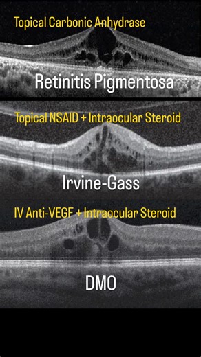 ‎شبكية طبية والتهابات مشيمة العين | د. شهاب العابد‎ on Instagram: "Nothing is "Just Basic". It’s All Connected. 🧠🧬 When looking at the Fovea, that dark band under the EZ isn't always fluid. It’s often just the elongated Outer Segments of the dense foveal cones. 📐 Mistaking normal anatomy for pathology is a trap we fall into when we skip the basics. 💡 My Philosophy: Medicine isn't just memorizing guidelines. It's deep-diving into Anatomy & Physiology. Why? Because Pathology is nothing but Phy