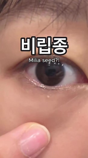 Effective Milia Removal Techniques in 15 Minutes