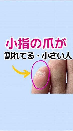 足の小指の爪が割れやすい人必見！爪のケア方法とは？