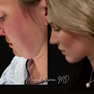 Deep Neck Lift