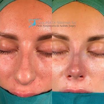 Nose Tip Surgery | Closed Rhinoplasty