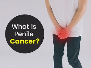 Penile Cancer: Know Symptoms, Risk Factors And Treatment Methods