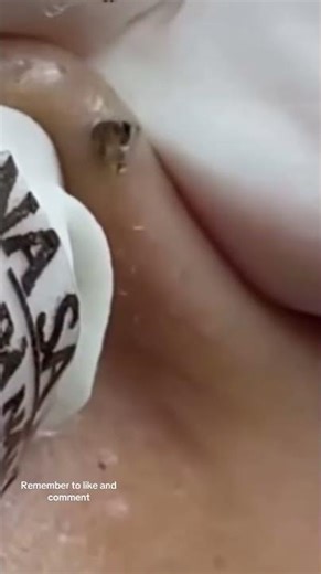 Pimple popping🤯🤯🤯🤢🤮🤢￼#pimples #pimplepoppingvideos #Acne #Disgusting #Gross #dermatologist ￼￼