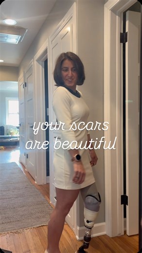 I spent a lot of time covering up. I was ashamed of my disability and how others saw me because of it. Now I run an organization educating and empowering my community! I’d love it if you could support my page by following 💕 #selfconfidenceiskey #selfworthjourney #selfworthmovement | Adaptive Amputees