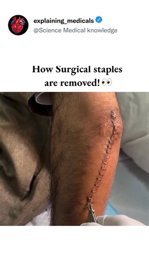 SCIENCE | MEDICAL | KNOWLEDGE on Instagram: "How to surgical 😷staples are removed .. 1. Inspection of the wound • The doctor/nurse checks if the incision is healed enough. • Redness, swelling, pus, or pain → staples may be kept longer. ⸻ 2. Cleaning the area • The skin around the staples is cleaned with an antiseptic solution (like betadine or alcohol swabs). ⸻ 3. Using a staple remover A sterile surgical staple remover is used. It has a small middle tooth that bends the staple for safe removal
