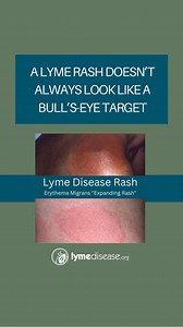 38 reactions · 20 shares | We often hear the terms “erythema migrans”...