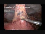 Laparoscopic-Thoracoscopic Esophagectomy • Video • MEDtube.net