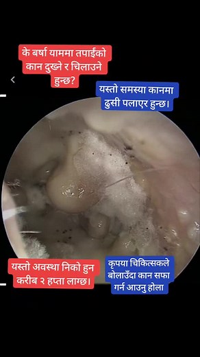 #onthisday #otomycosis #earfungus #earitching #ear #monsoon #rain #fypシ #foryou