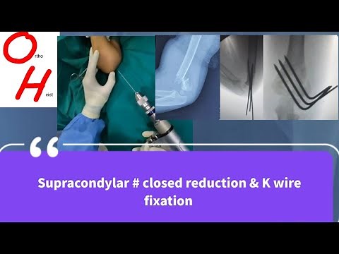 CLOSED REDUCTION & K WIRE FIXATION FOR SUPRACONDYLAR FRACTURE OF HUMERUS IN CHILDREN