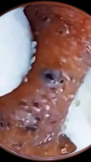 Complete removal of deep blackheads - Deep skin cleansing of blackheads - Leaving more blackhead-free skin . . . #skin #blackhead #pimples #puntosnegros #squeeze #fypシ゚ #blackheadsremoval