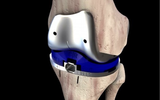 LEGION…… TKA Animation Full Surgery人工膝关节置换术