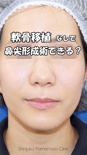 軟骨移植なしでも「鼻尖形成術」できます❕ #鼻整形 #shortvideo #美容整形 #他院修正 #鼻尖形成
