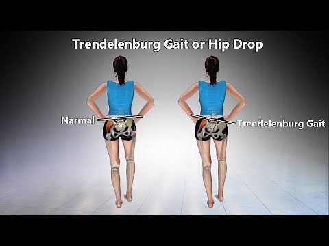Exercises for Trendelenburg Gait or Hip Drop