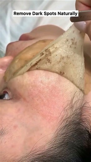 ✨ Pigmentation Removal Secret for Glowing Skin | Get Clear, Even-Toned Skin Naturally #skincare